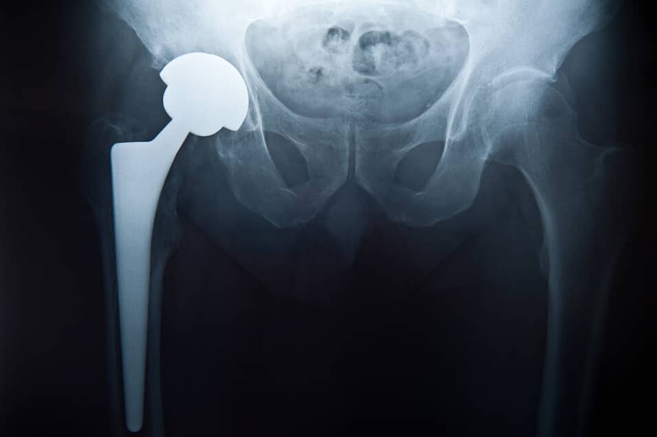 Symptoms of a Defective Hip Replacement